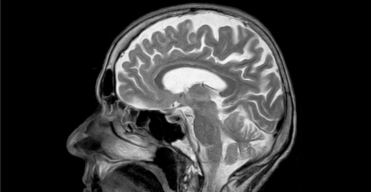 Cerebrovascular Disease – A Grave Neurological Disorder